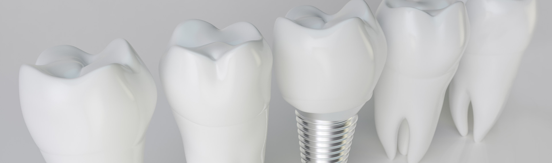 Materialien für Zahnimplantate